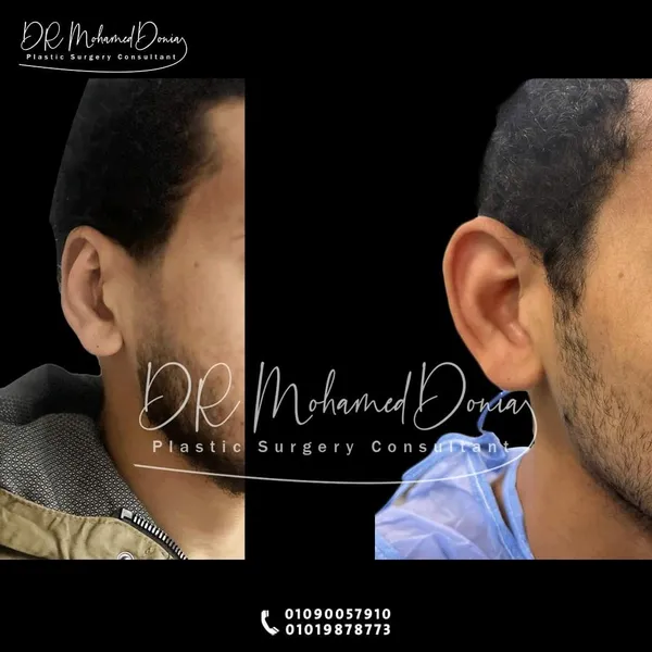 img of تجميل الأذن الخفاشية بدون ألم تماماً